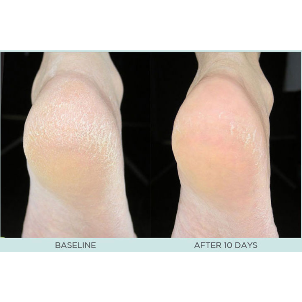 Callus and Cracked Skin Repair